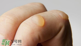 燙傷起泡要挑破嗎？燙傷起泡怎么處理？