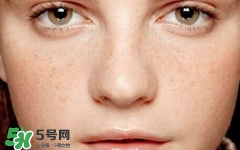 長(zhǎng)斑是什么原因引起的？祛斑效果最好的方法