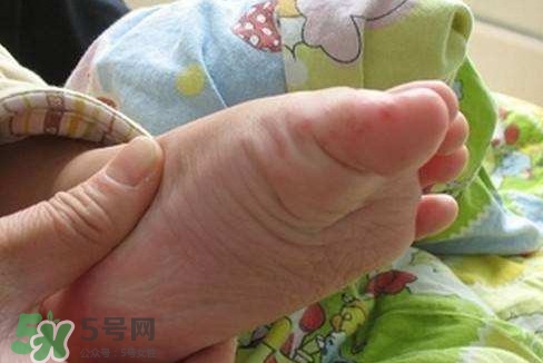手足口病如何預(yù)防？手足口病怎樣預(yù)防
