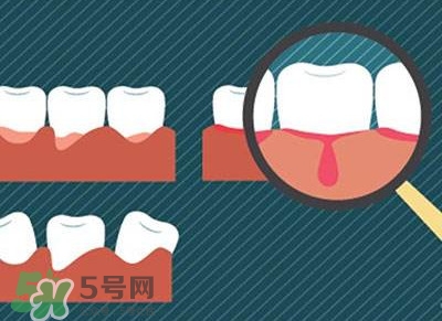 牙齦出血是什么原因？牙齦出血怎么回事