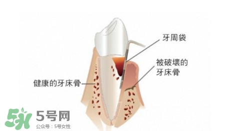 牙周炎怎么治療？牙周炎怎么治好