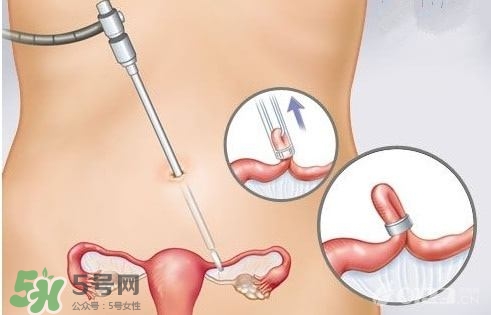 女人怎樣避孕最安全？對女人最好的避孕方法