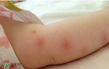 嬰兒蚊子咬了怎么消腫？嬰兒蚊子咬了怎么消腫止癢最快？