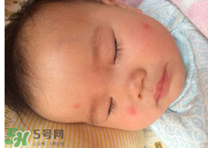 嬰兒蚊子咬了怎么消腫？嬰兒蚊子咬了怎么消腫止癢最快？