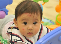 嬰兒被蚊子咬了如何去紅點(diǎn)？被蚊子咬后紅點(diǎn)如何去除？