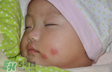 嬰兒被蚊子咬了如何去紅點(diǎn)？被蚊子咬后紅點(diǎn)如何去除？