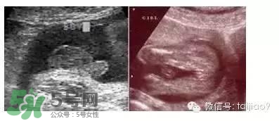 B超單數(shù)據(jù)怎么看男女？B超單看男女準(zhǔn)嗎？