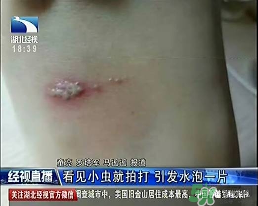 隱翅蟲(chóng)有毒嗎？隱翅蟲(chóng)會(huì)毀容嗎？