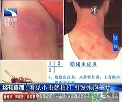 隱翅蟲(chóng)有毒嗎？隱翅蟲(chóng)會(huì)毀容嗎？