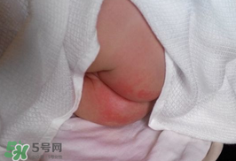 尿布疹怎么辦？寶寶尿布疹擦什么藥好？