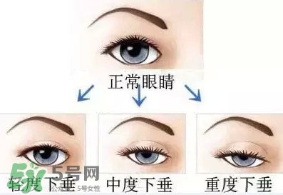 長(zhǎng)期用假睫毛雙眼皮貼對(duì)眼睛有什么傷害？