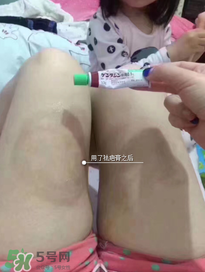 日本msd祛疤膏怎么樣？日本msd祛疤膏有用嗎？