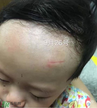 日本msd祛疤膏是抗生素嗎？日本msd祛疤膏是不是抗生素？