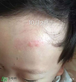 日本msd祛疤膏是抗生素嗎？日本msd祛疤膏是不是抗生素？