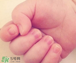 寶寶指甲凹凸不平是什么原因？寶寶指甲凹凸不平正常嗎？
