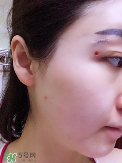 冷凍點(diǎn)痣是什么 冷凍點(diǎn)痣和激光點(diǎn)痣哪個好