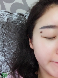 冷凍點(diǎn)痣是什么 冷凍點(diǎn)痣和激光點(diǎn)痣哪個好