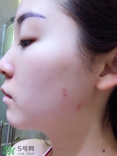 冷凍點(diǎn)痣是什么 冷凍點(diǎn)痣和激光點(diǎn)痣哪個好