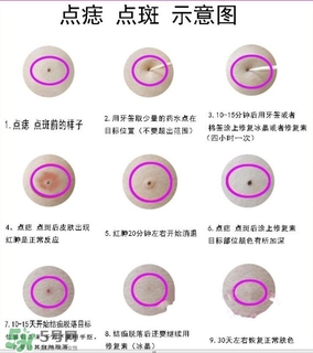 藥水點痣和激光點痣哪個好？各有什么優(yōu)缺點
