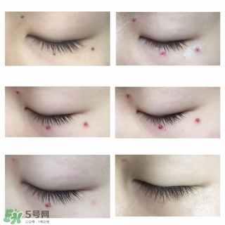 藥水點痣和激光點痣哪個好？各有什么優(yōu)缺點