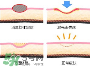 藥水點痣和激光點痣哪個好？各有什么優(yōu)缺點