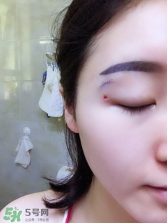 冷凍點(diǎn)痣是什么 冷凍點(diǎn)痣和激光點(diǎn)痣哪個好