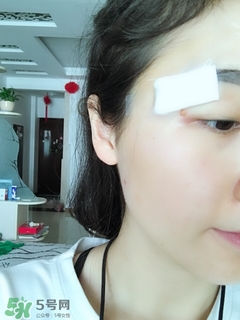 冷凍點(diǎn)痣是什么 冷凍點(diǎn)痣和激光點(diǎn)痣哪個好