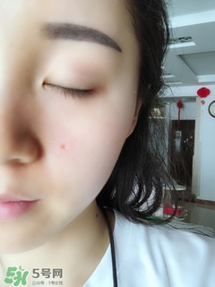 冷凍點(diǎn)痣是什么 冷凍點(diǎn)痣和激光點(diǎn)痣哪個好