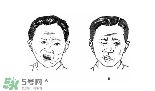 面癱是什么導(dǎo)致的？面癱多久徹底恢復(fù)正常