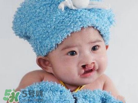 兔唇可以治嗎？兔唇修補術(shù)