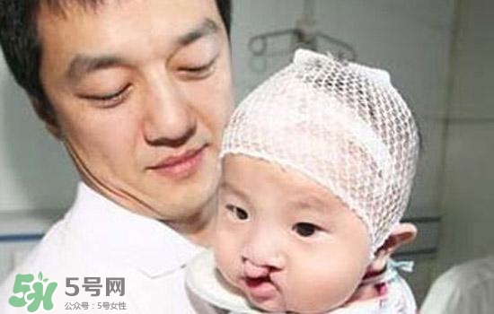 兔唇是什么？兔唇是什么原因造成的？