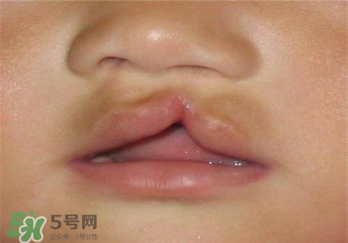 兔唇能檢查出來嗎？兔唇能完全修復(fù)嗎？