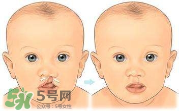 兔唇能檢查出來嗎？兔唇能完全修復(fù)嗎？