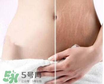 妊娠紋怎么長在大腿上了？妊娠紋會(huì)不會(huì)長在大腿上？