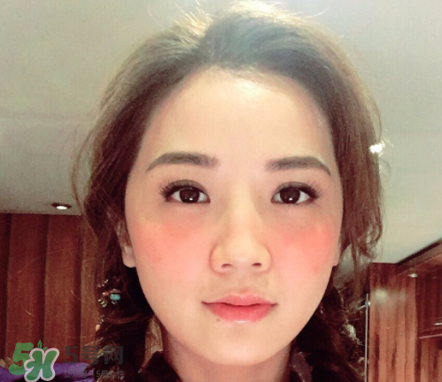 夏天可以點痣嗎？夏天點痣后要注意什么？