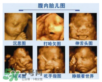 四維彩超有必要做嗎？四維彩超檢查不出什么？