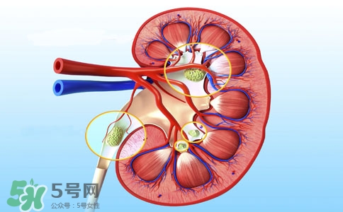 腎結(jié)石有什么癥狀？腎結(jié)石原因