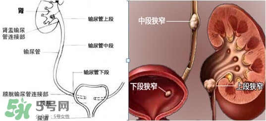 腎結(jié)石怎么治最好？腎結(jié)石的醫(yī)治方法