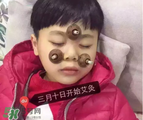 艾灸貼可以治咳嗽嗎？艾灸貼可以治退燒嗎？