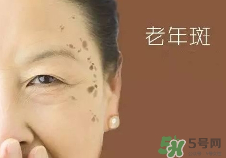 老年斑多大年齡開(kāi)始有？為什么牙膏能去老年斑？