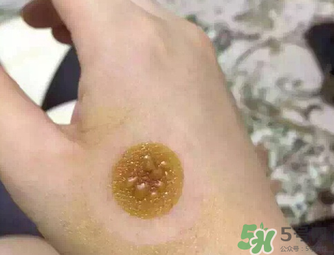 艾灸貼后有水泡怎么辦？貼艾灸貼應(yīng)注意些什么？