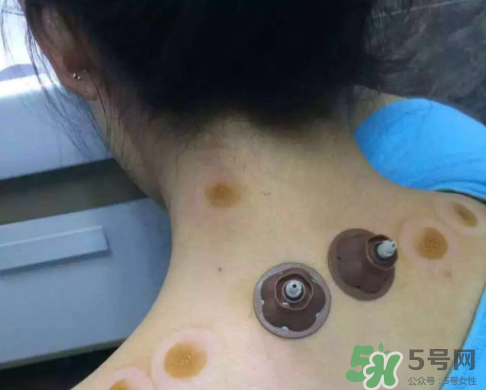 艾灸貼后有水泡怎么辦？貼艾灸貼應(yīng)注意些什么？