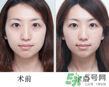 填充淚溝有風險嗎？填充淚溝的方法