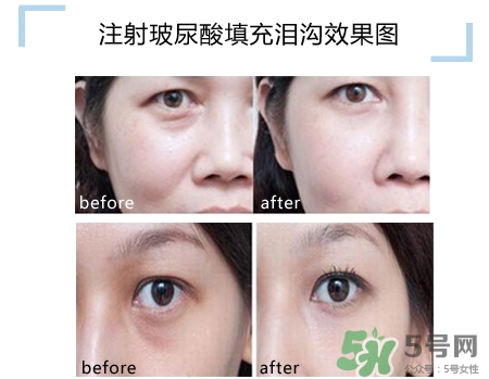 玻尿酸填充淚溝多久恢復(fù)自然？玻尿酸填充淚溝的危害