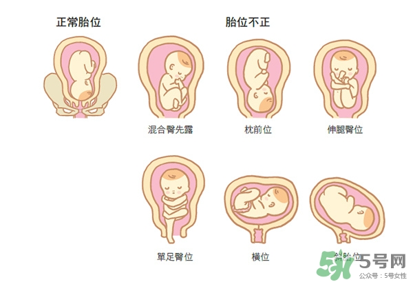 胎位不正如何矯正？胎位不正一定要剖腹產(chǎn)嗎？