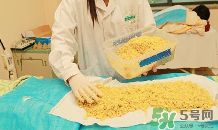 隔姜灸效果怎么樣？隔姜灸好還是直接灸好
