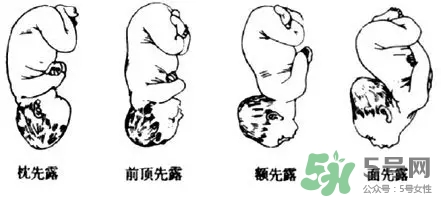 胎位不正能順產(chǎn)嗎？胎位不正怎么辦？