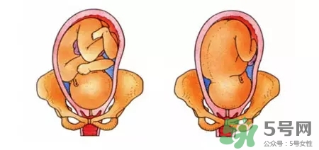 胎位不正能順產(chǎn)嗎？胎位不正怎么辦？