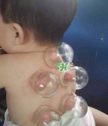 拔火罐后顏色多久消失？拔火罐印子多久能消除？