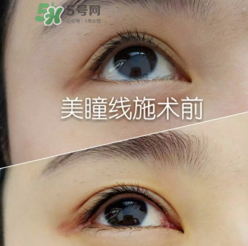 做美瞳線可以吃雞蛋嗎？做美瞳線能吃雞蛋嗎？